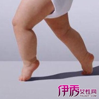 【图】宝宝罗圈腿的图片 如何判断罗圈腿