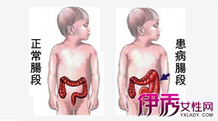 【图】先天性巨结肠检测方式 五大检测知道孩子是否得巨结肠