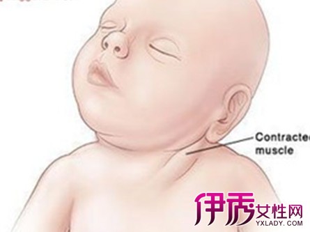 【宝宝斜颈的症状图片】【图】宝宝斜颈的症状