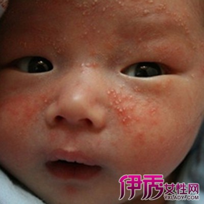 【新生儿脓疱疹】【图】新生儿脓疱疹是什么 