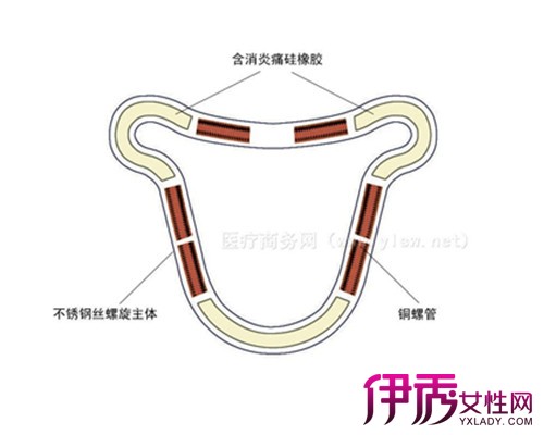 【图】宫型节育环的图片展示 节育环的用法揭露