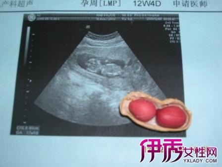 【怀孕一个半月胎儿图】【图】怀孕一个半月胎