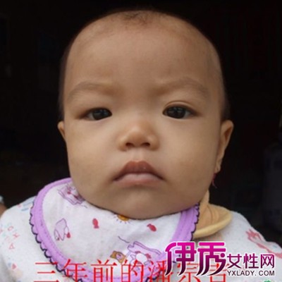 【小孩地中海贫血图片】【图】小孩地中海贫血