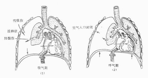 【图】肺部发育不良得气胸的原因有哪些 3类原因告诉你