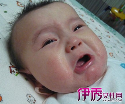 【宝宝湿疹图片】【图】宝宝湿疹图片 婴儿湿