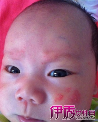 【宝宝脸上长湿疹图片】【图】高清宝宝脸上长湿疹