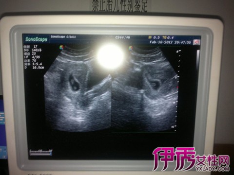 【怀孕两个月胎儿彩超】【图】怀孕两个月胎儿