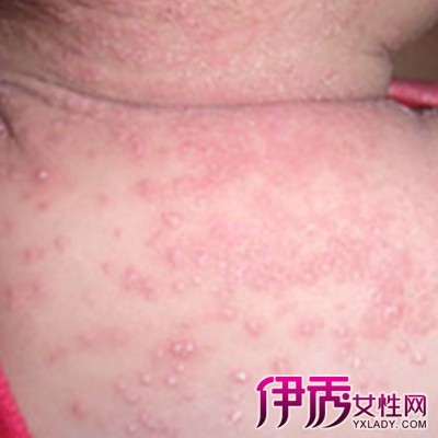 白尖俗称小儿湿疹,是一种变态反应性皮肤病,就是平常说的过敏性皮肤病