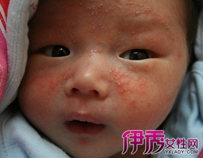 【婴儿脸上起湿疹小妙招】【图】婴儿脸上起湿