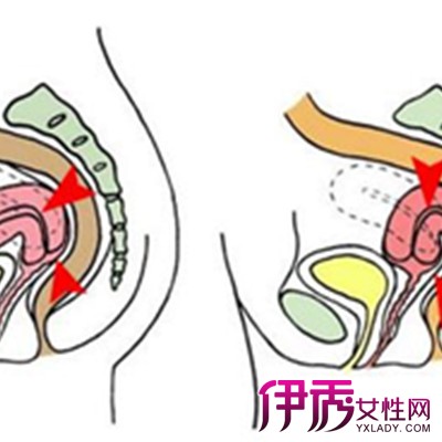 【图】子宫前位和后位有什么区别 子宫后位的3个注意事项知道吗