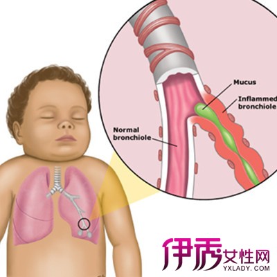 【婴儿支气管炎的症状】【图】婴儿支气管炎的
