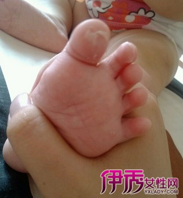 【图】小朋友脚趾头脱皮是怎么回事 三大方法呵护宝宝脚丫