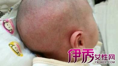 【婴儿头皮湿疹图片】【图】一些婴儿头皮湿疹