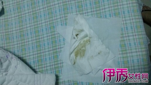 【图】怀孕后期分泌物增多 教你快速诊断和治疗