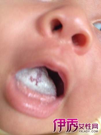 【图】婴儿舌头发白是什么回事 教你从舌头看宝宝健康状况