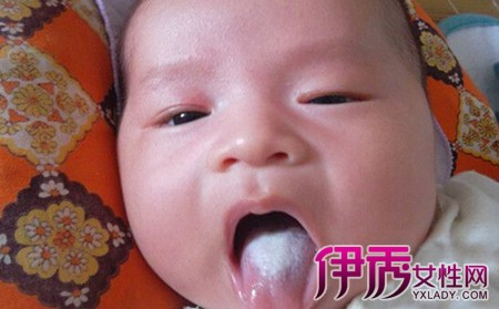 【婴儿舌头发白】【图】婴儿舌头发白是什么回