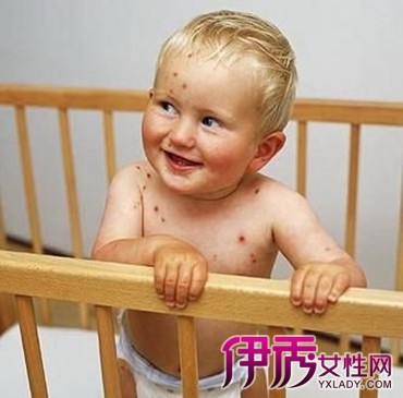 【宝宝长水痘初期图片】【图】宝宝长水痘初期