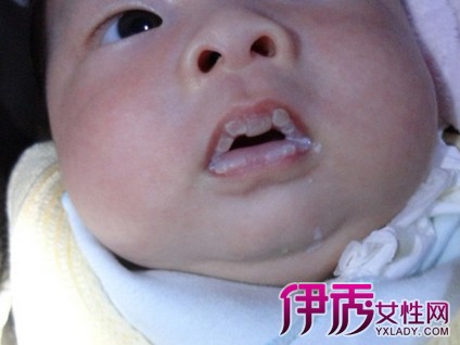 【婴儿嘴唇发白】【图】婴儿嘴唇发白有5个原