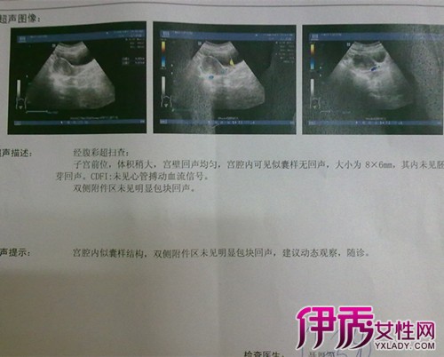 【怀孕一个月胎儿图b超】【图】怀孕一个月胎