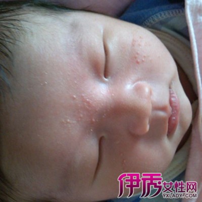 【刚出生的宝宝脸上起了小红点】【图】刚出生