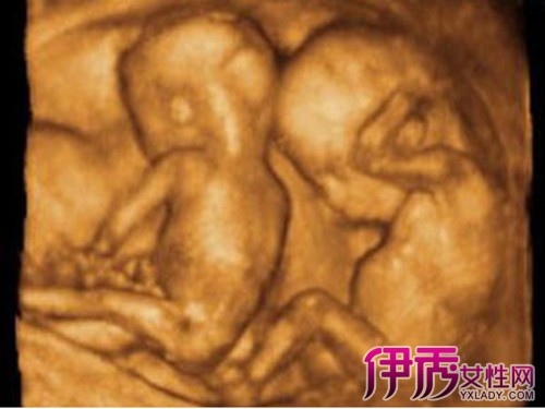 四维彩超】【图】怀孕五个月胎儿四维彩超图欣