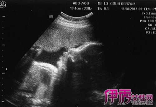 【图】胎儿在肚子趴着的图片集锦 为你详解妈妈怀孕期间注意事项