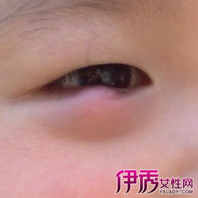 【图】小孩眼睛长麦粒肿怎么办才好 妈妈都学习的治疗方法