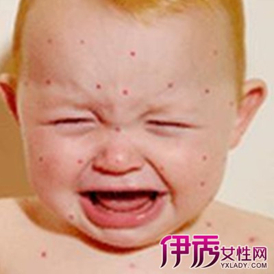 【图】小孩水痘图片初期分享小孩出水痘的护理
