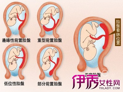 【图】边缘性前置胎盘对怀孕有影响吗 专业医生为你解答疑惑