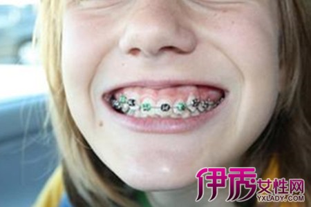 【图】儿童龅牙图片信息 儿童牙齿矫正注意事项有哪些