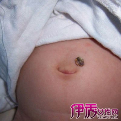 【新生儿脐带发炎图片】【图】盘点新生儿脐带