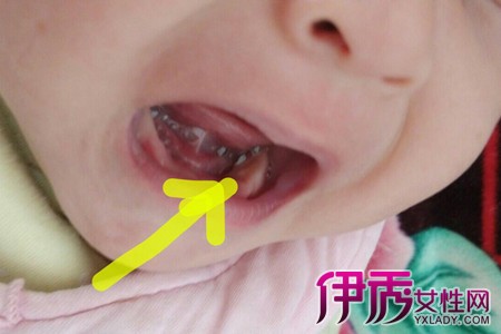 图】脆弱的婴儿牙床上有白点 可能是鹅口疮不