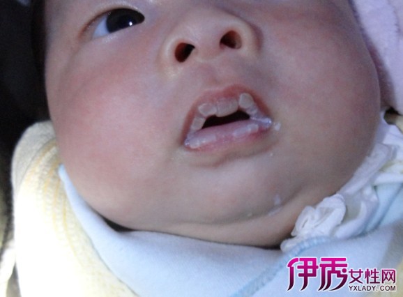 婴儿上嘴唇中间起白泡是什么 警惕口腔溃疡疾