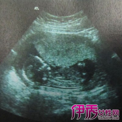 【图】怀孕两个月男孩b超图片 9步教你看懂怀孕b超图