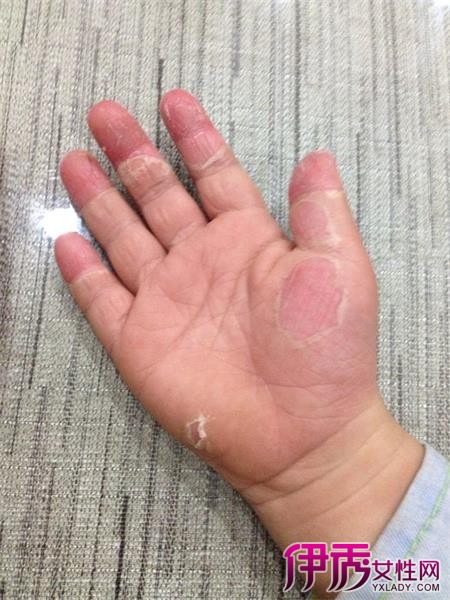 【图】儿童手指头脱皮图片 预防手指脱皮的小妙招