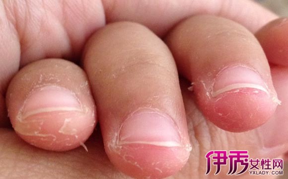 【图】儿童手指头脱皮图片 预防手指脱皮的小妙招