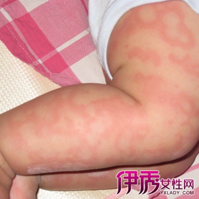 小儿常在接触过敏原不久就表现出皮肤过敏,身体不适症状和行为问题.