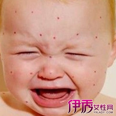 【小孩出麻疹的症状图片】【图】小孩出麻疹的