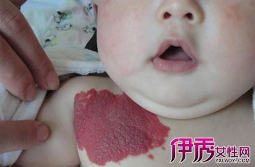 【出生婴儿血管瘤图片】【图】最新出生婴儿血