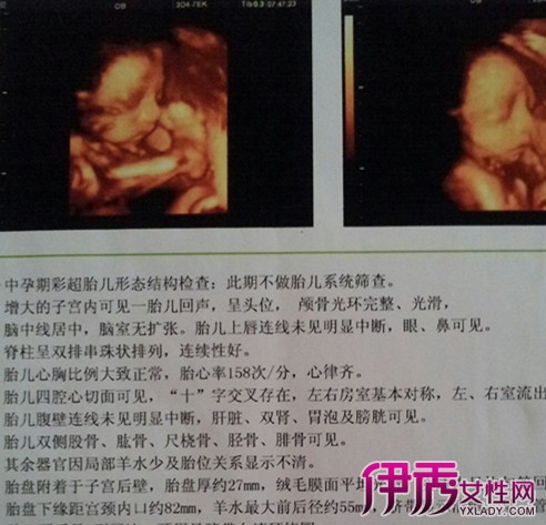 【怀孕三个月彩超图】【图】怀孕三个月彩超图
