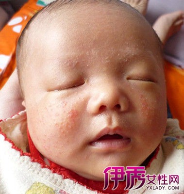 【婴儿湿疹的图片】【图】婴儿湿疹的图片大全