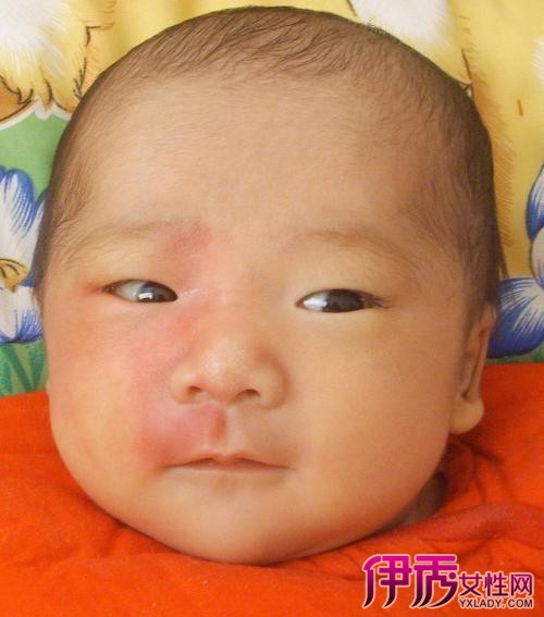 【新生儿脸上红斑】【图】分析新生儿脸上红斑