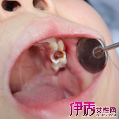 【宝宝牙齿钙化图片】【图】宝宝牙齿钙化图片