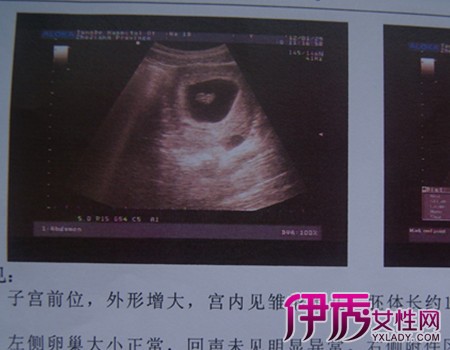 【怀孕b超图片一个月】【图】揭秘怀孕b超图