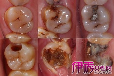 【图】儿童虫牙怎么治 小孩虫牙要注意些什么?