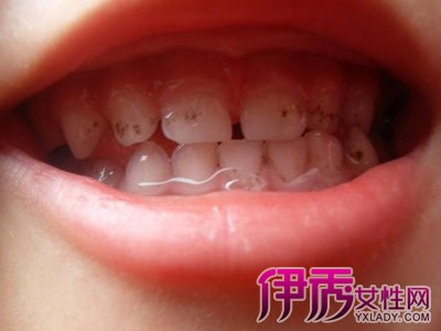 【图】小孩牙齿发黑图片及疗法 4种教你告别黑牙齿的好方法