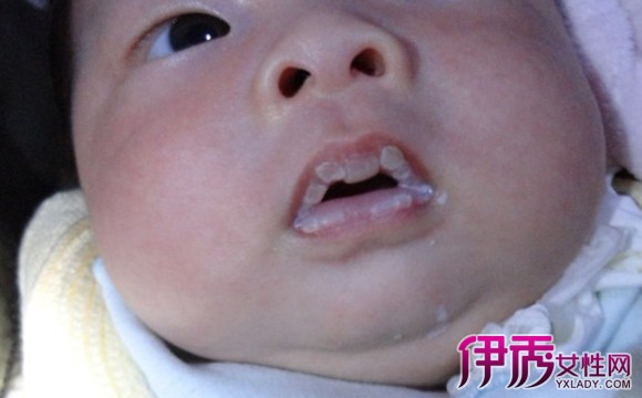 【宝宝吃奶上嘴唇起泡】【图】宝宝吃奶上嘴唇