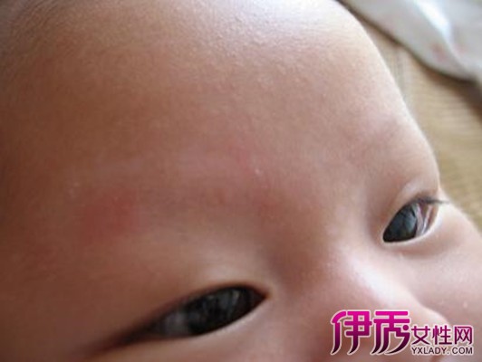 【婴儿脸上有白斑怎么办】【图】婴儿脸上有白