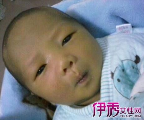 【小孩黄胆高怎么治】【图】小孩黄胆高怎么治