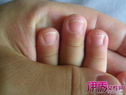 【儿童手指头脱皮是怎么回事】【图】儿童手指